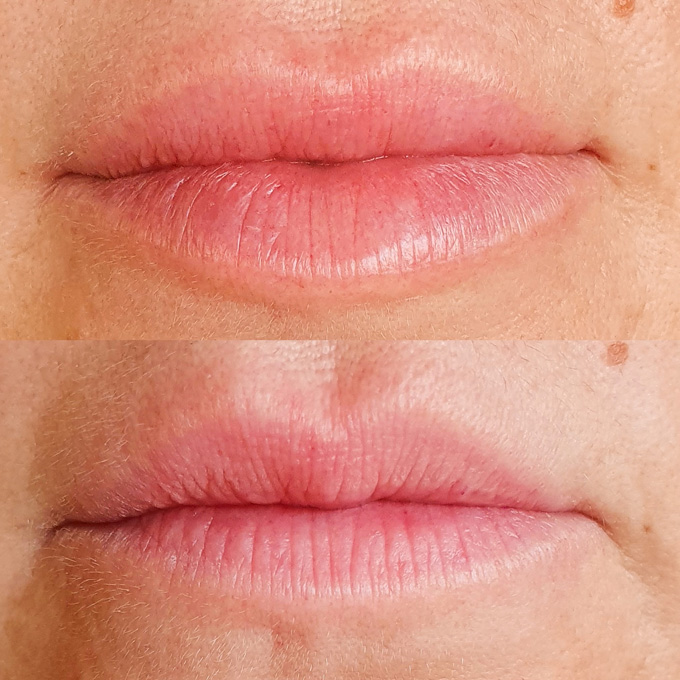 Osvježenje usnama hijaluronom, prije i poslje