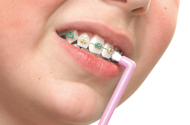 Održavanje oralne higijene uz nošenje ortodontskog aparata